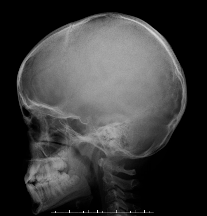 Continuum Imagen radiológica en el cráneo en una niña escolar