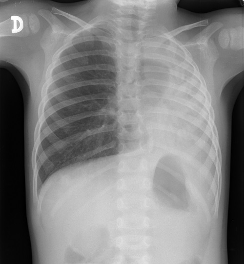 Continuum: Diagnóstico diferencial de atelectasia pulmonar completa