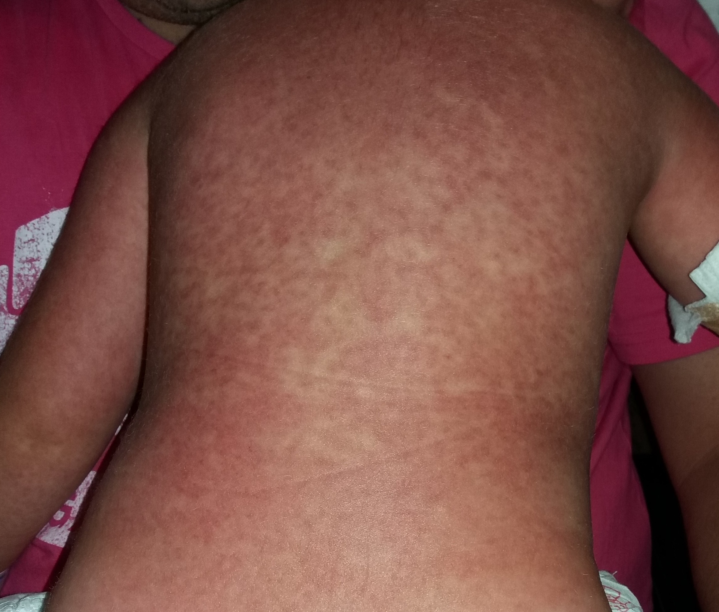 Continuum: Niño de 4 años con fiebre y exantema
