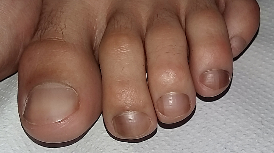 Tumores en las uñas cuáles son y cómo identificarlos  Cirugía Estética  Madrid  Clínica FEMM