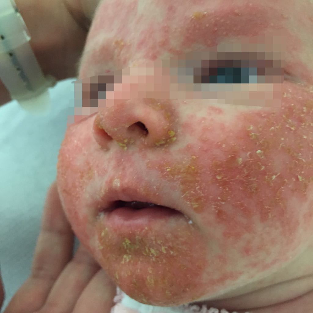 Costra láctea (dermatitis seborreica bebés)
