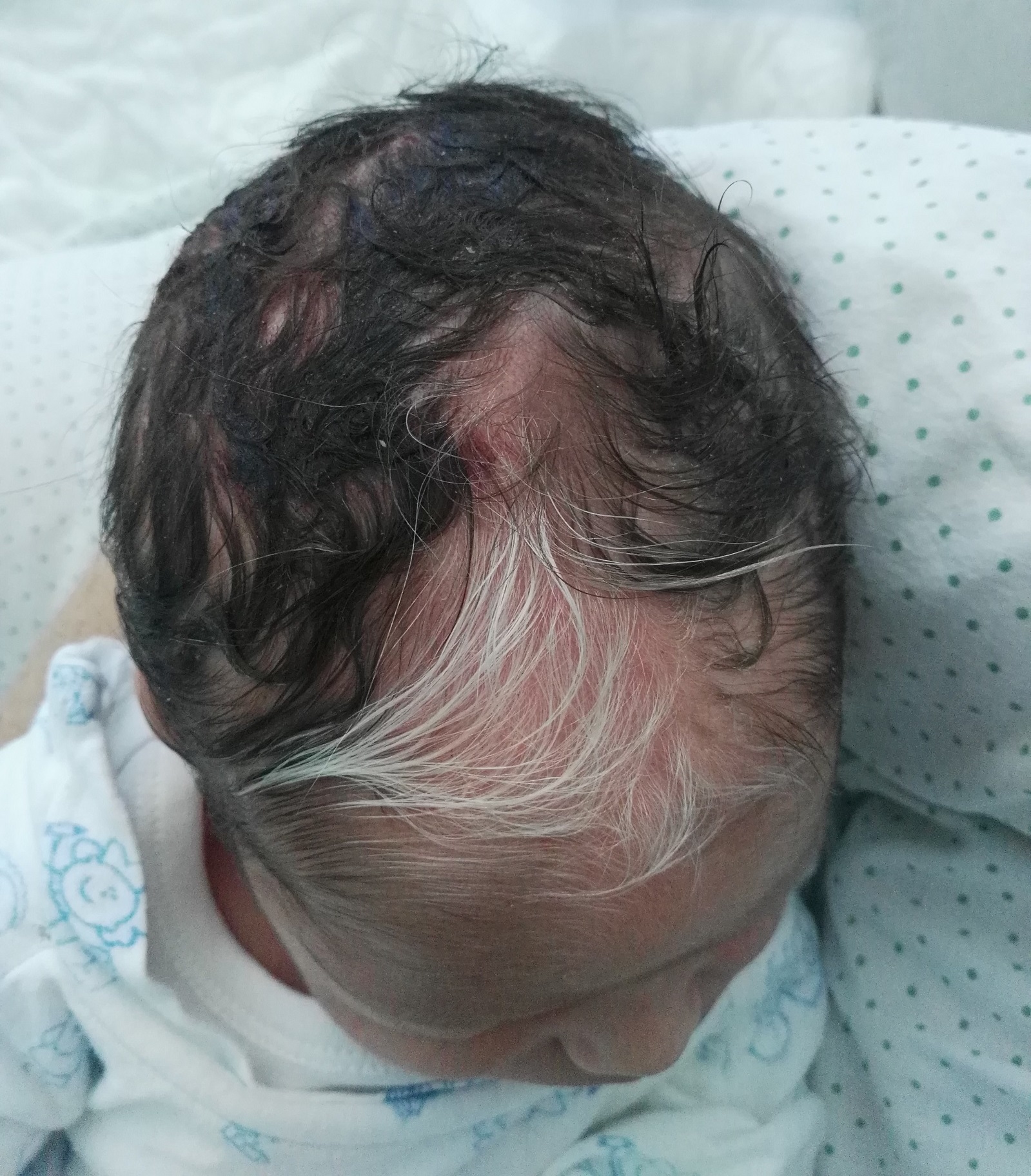 Ministerio relajarse correr Continuum: Mechón de pelo blanco en un neonato