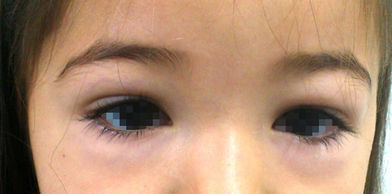 Continuum Ni a Con Edema Palpebral Fiebre Y Hepatomegalia