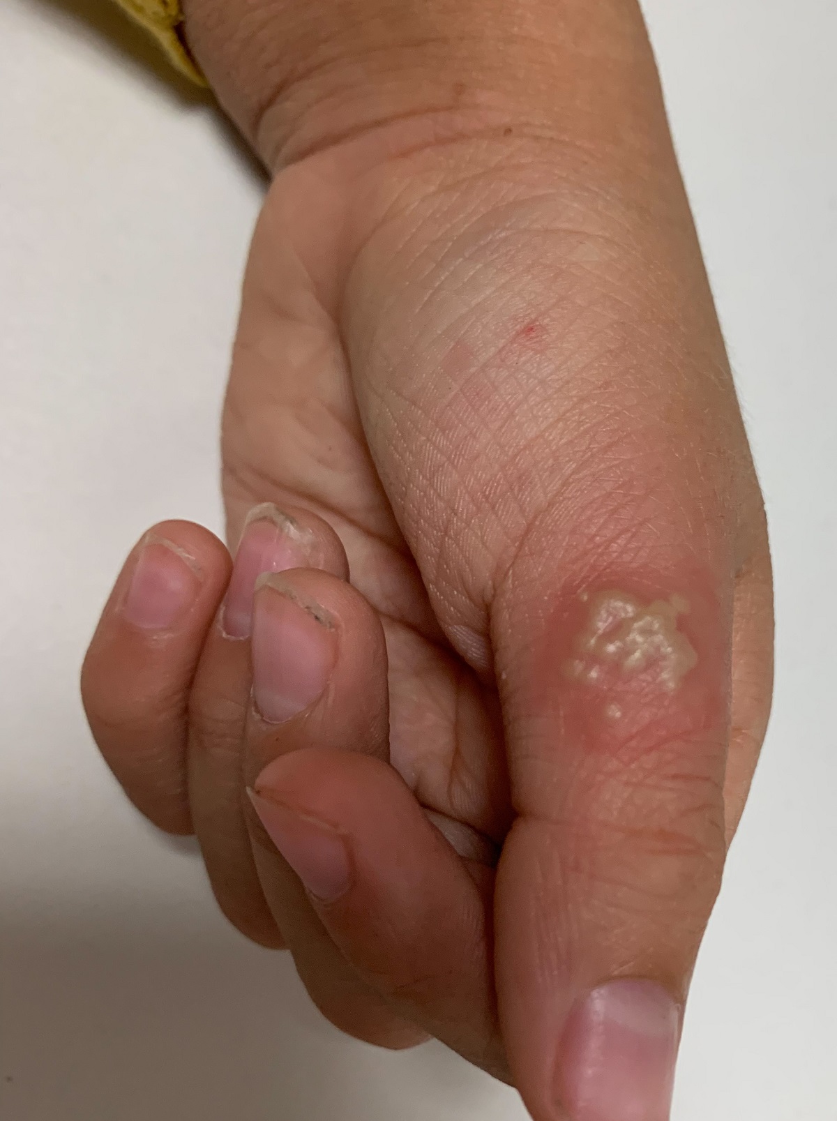 Continuum: Lesiones en dedo