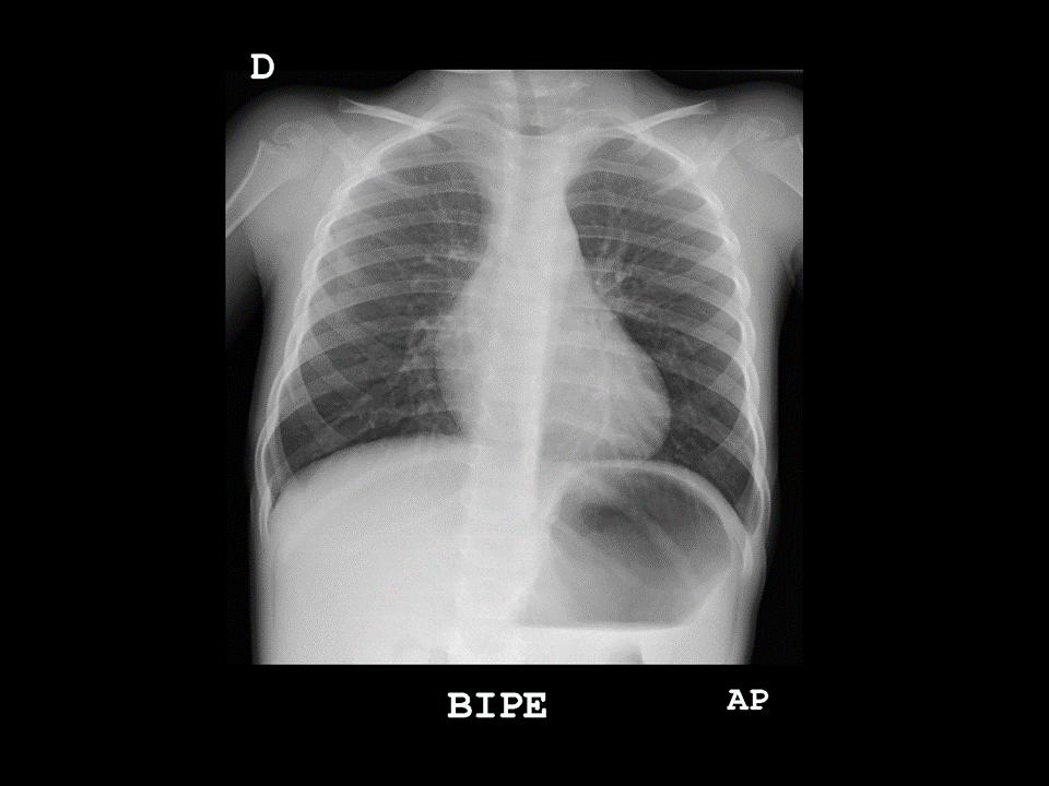 Continuum: Radiografía de tórax: indicaciones, diagnóstico y casos